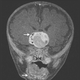 Image for article titled Surgeons shocked to find fully formed teeth in a baby's brain tumor